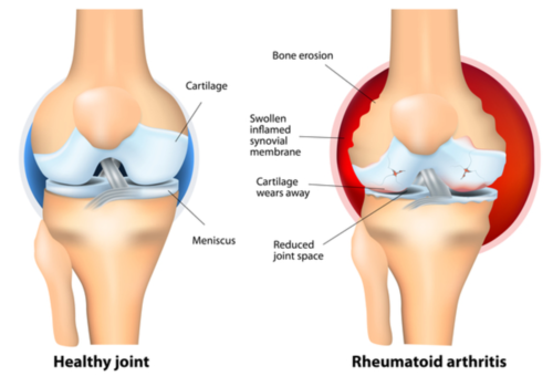 Rheumatoid-Arthritis